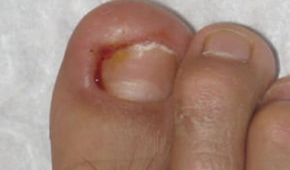 甲沟炎视频,视频解析病因、症状及治疗全攻略